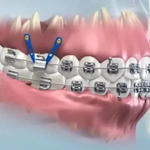 Qué son los microtornillos en ortodoncia